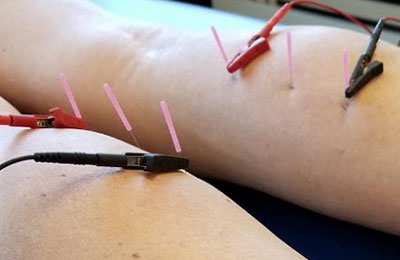 Umesh Bansal Physiotherapy services needling