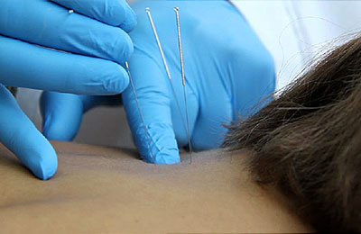 Umesh Bansal Physiotherapy dry needling 